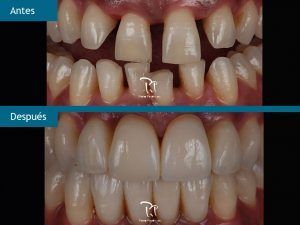 Implantes dentales en área estetica